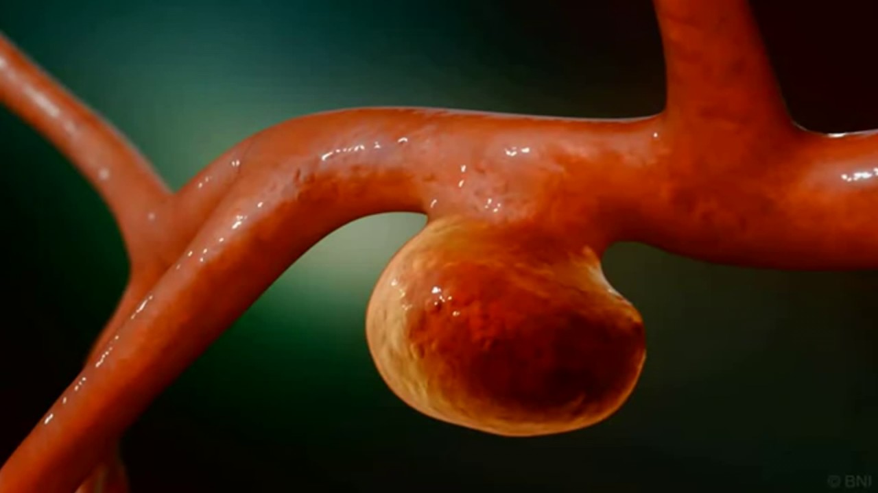 ENDOVASKÜLER ANEVRİZMA