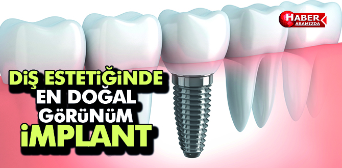 İmplantta Doğal Görünüm Sağlanır mı?