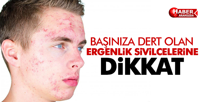 Ergenlik sivilceleri tıbbı müdahale gerektirebilir