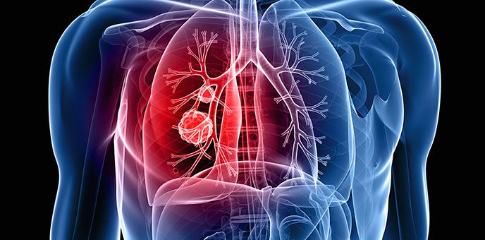 Akciğer Kanserinin 9 Belirtisine Dikkat