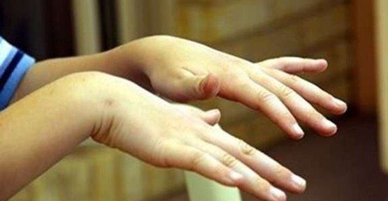 Ellerde titreme ‘Parkinson hastalığının habercisi olabilir