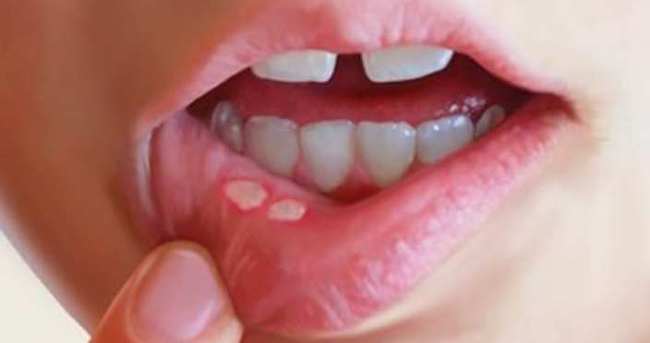 Ağız yaraları neden olur, tedavisi nasıl yapılır?