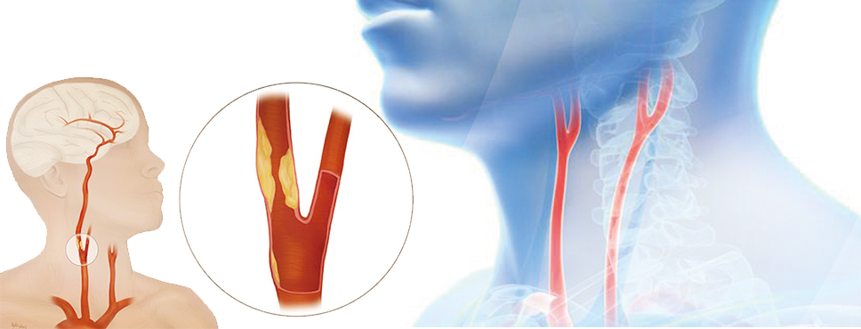 Vücudun Gizli Tehlikesi Şah Damar Tıkanıklığı