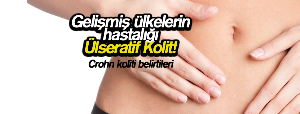 Gelişmiş ülkelerin hastalığı Ülseratif Kolit!