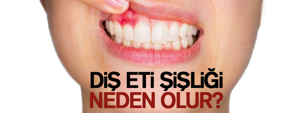 Diş Eti Şişlikleri Neden Olur?