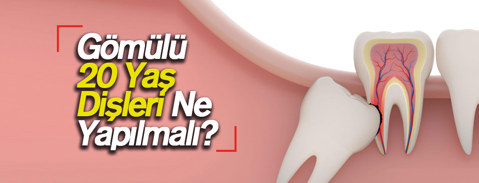 Gömülü 20 Yaş Dişleri Ne Yapılmalı?