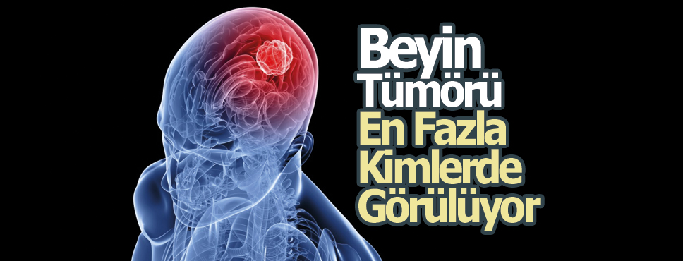 Beyin Tümörü En Fazla Kimlerde Görülüyor