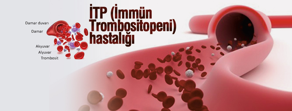 İTP (İmmün Trombositopeni) hastalığı